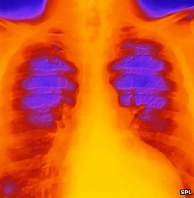 Radiografía de un paciente que sufre de miocardiopatía.