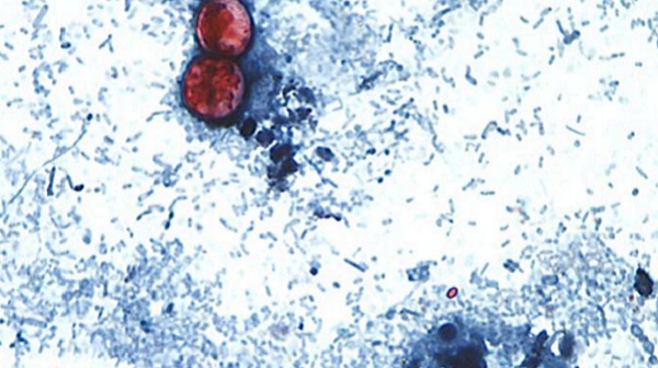 La ciclosporosis es una enfermedad intestinal causada por el parásito Cyclospora cayetanensis.
