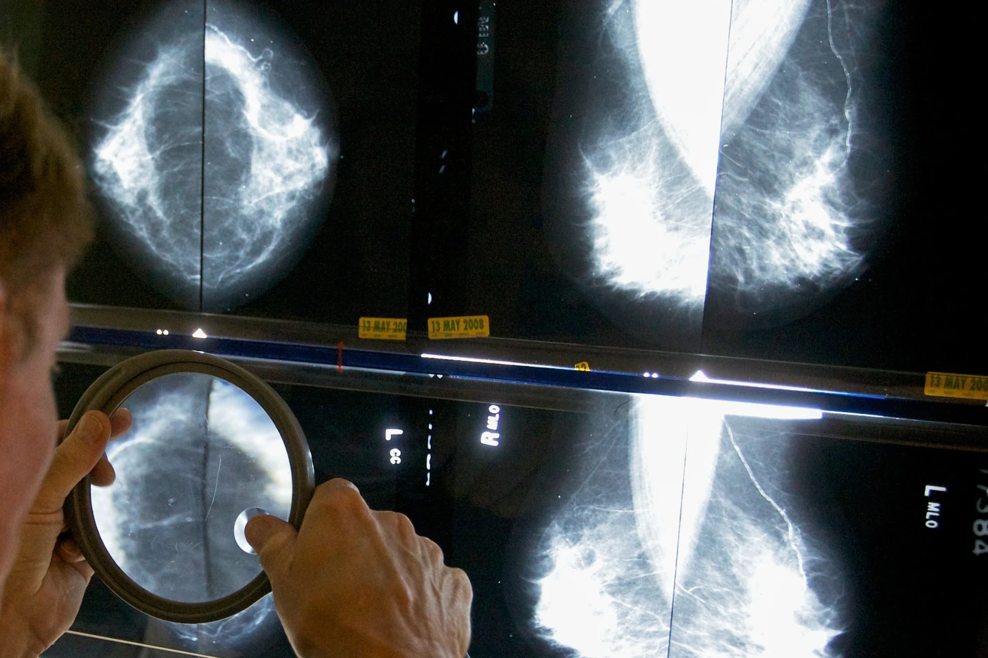 Un radiólogo utiliza una lupa para examinar mamografías en busca de cáncer de mama en Los Ángeles el 6 de mayo de 2010. (Foto AP/Damian Dovarganes, Archivo)