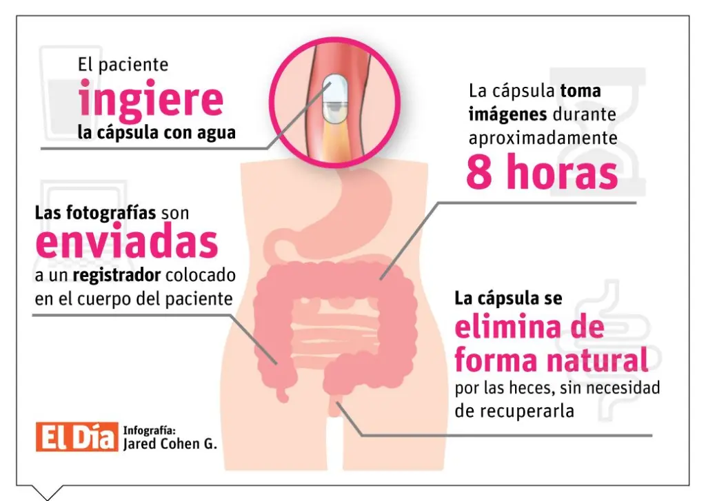 Cápsula endoscópica: una pequeña cámara capaz de viajar a través del intestino