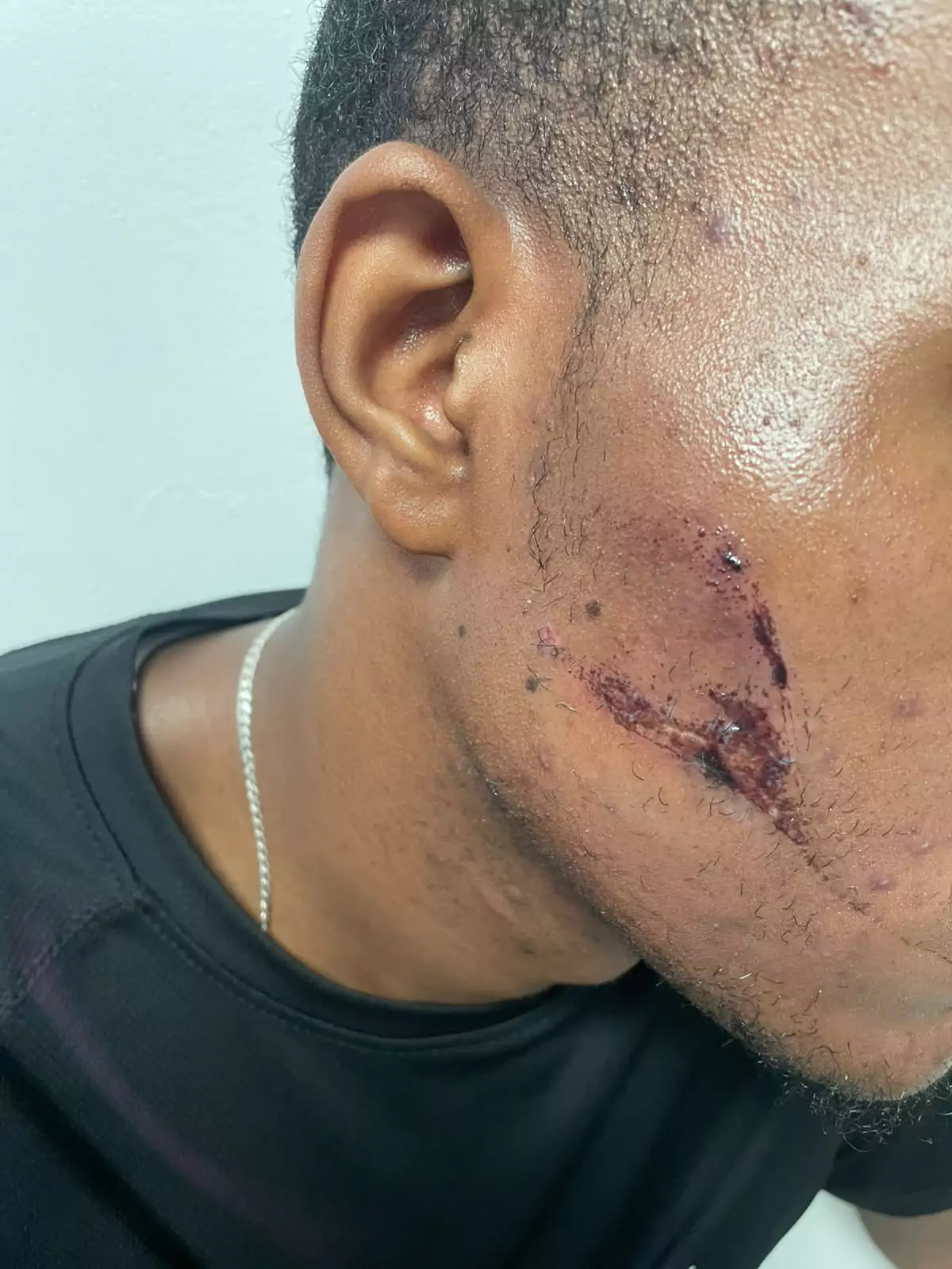 Herida en la mejilla de uno de los jóvenes heridos tras un choque con un buggy en Punta Cana