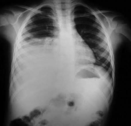 Los informes e hipótesis preliminares sugieren que la exposición letal al agente infeccioso (relacionado con la bacteria Yersinia pestis