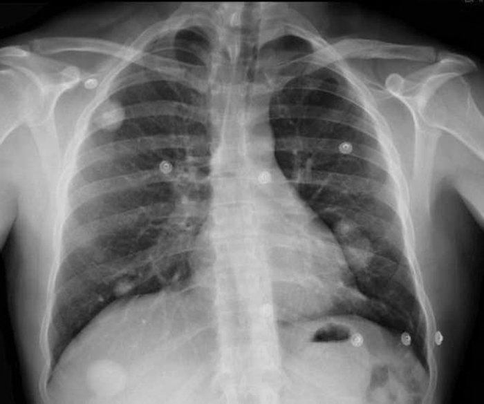 Nódulo pulmonar